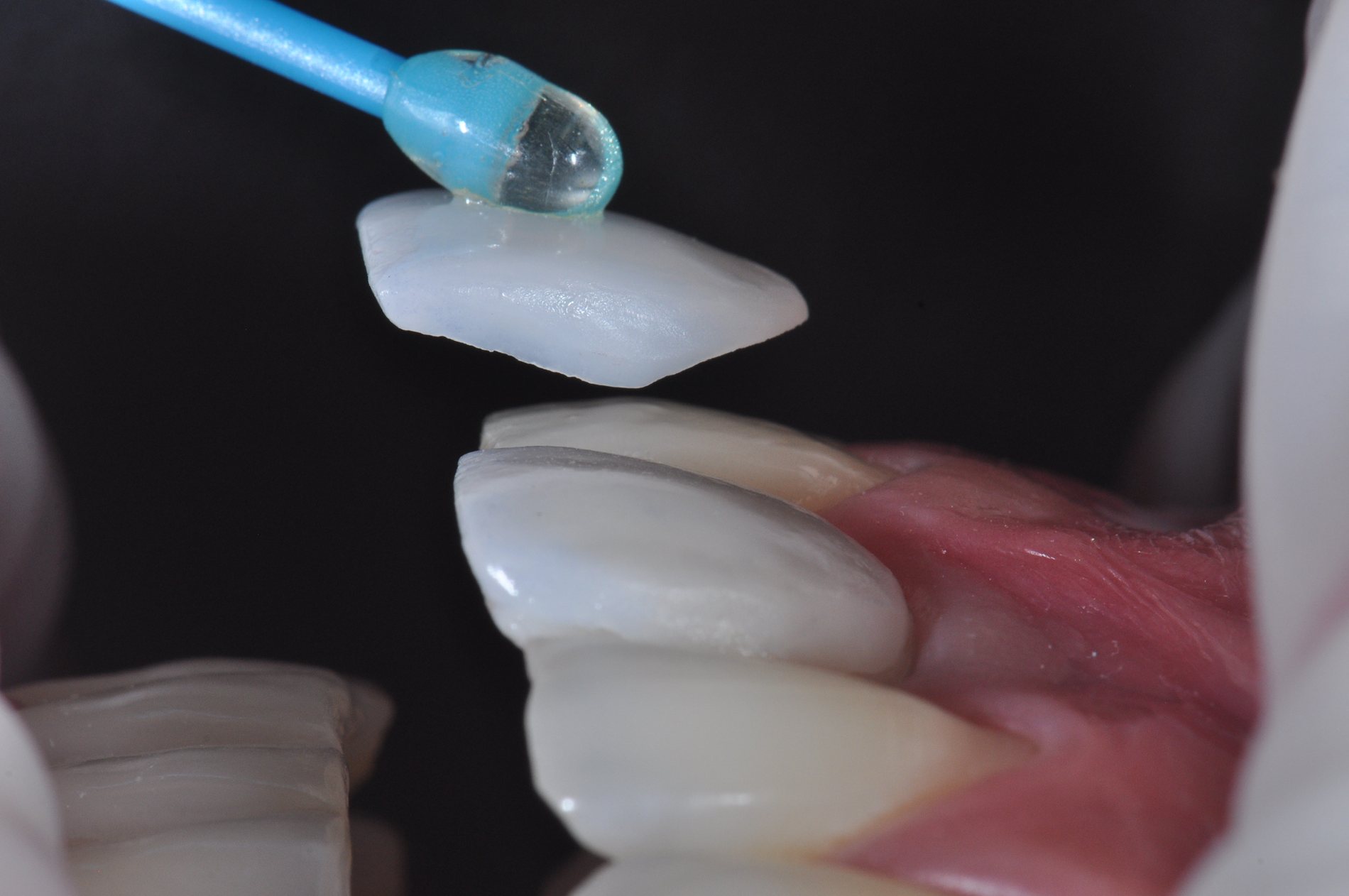 Faceta de porcelana sendo posicionada com precisão